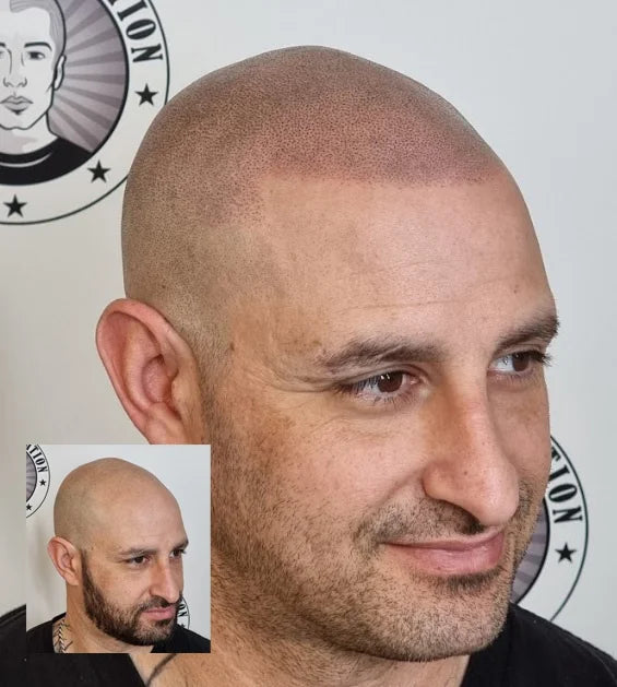 My Transformation, Scalp Micropigmentation Perth, Hair Tattoo Perth, MP Perth, SMP WA, Perth Australia