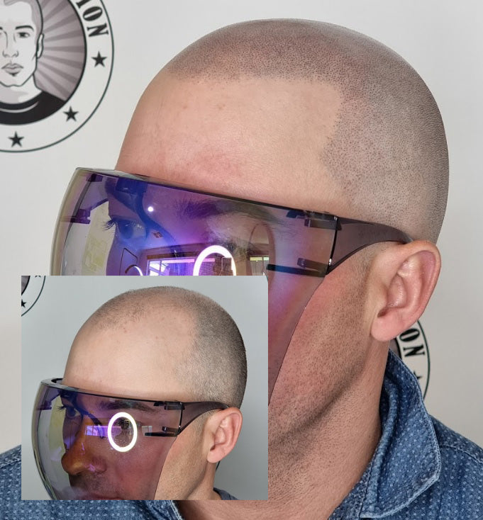 My Transformation, Scalp Micropigmentation Perth, Hair Tattoo Perth, SMP Perth, SMP WA, Perth Australia