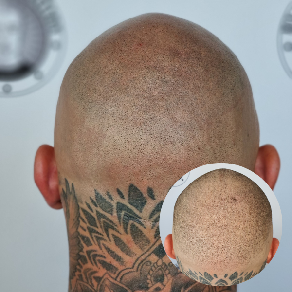 My Transformation, Scalp Micropigmentation Perth, Hair Tattoo Perth, MP Perth, SMP WA, Perth Australia