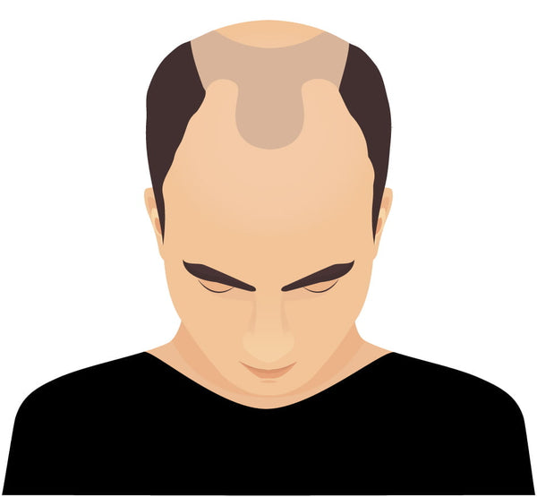 Balding solution for men add density to thinning areas for the appearance of thick strong hair Perth