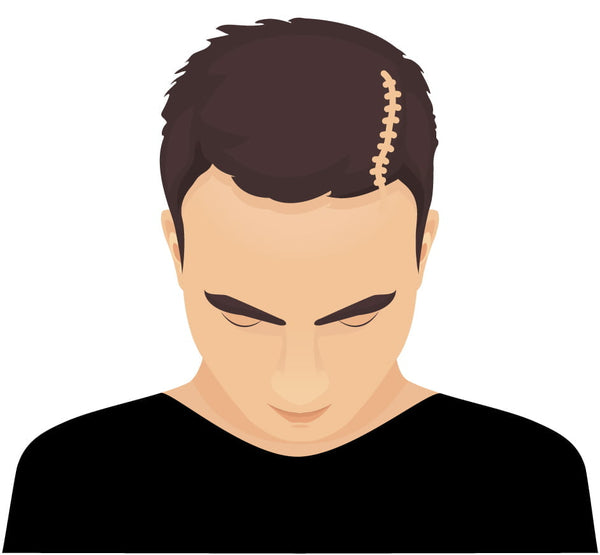 Scalp Micropigmentation SMP Hair Tattoo for scars on men and women Perth WA Australia