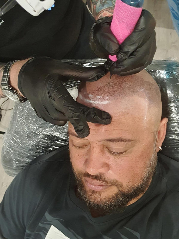 Scalp Micropigmentation in action at My Transformation Perth