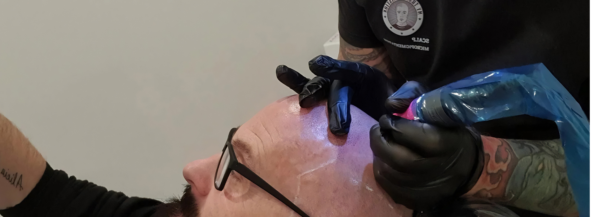 My Transformation, Scalp Micropigmentation Perth, Hair Tattoo Perth, SMP Perth, SMP WA, Perth, Australia, Men's hair Tattoo, SMP in action, Scalp Micropigmentation