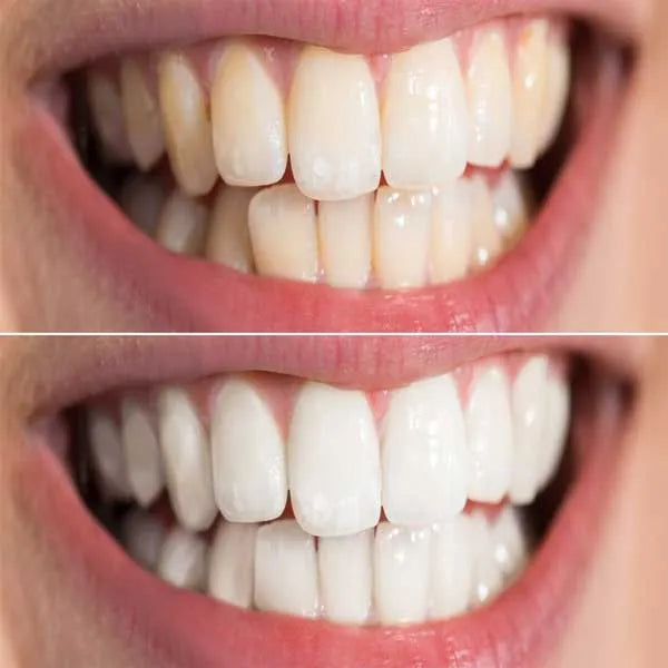 Teeth Whitening Perth