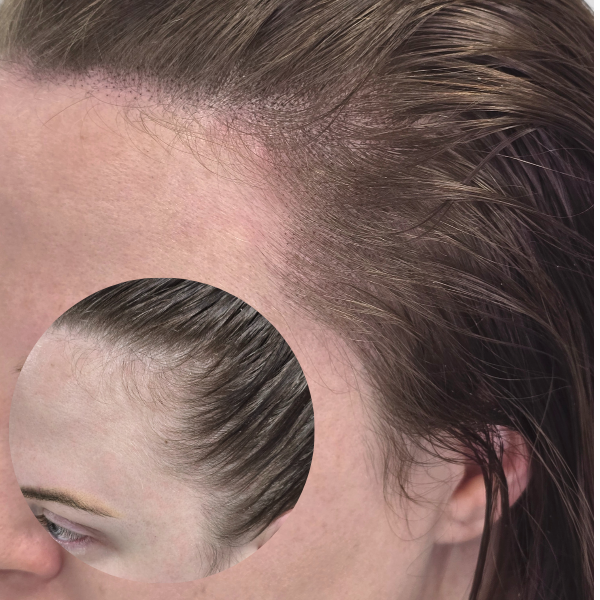 My Transformation,, Women's Hair Tattoo Perth, SMP Perth, SMP WA, Sclp Micropigmentation For Women , Hair Density For Women